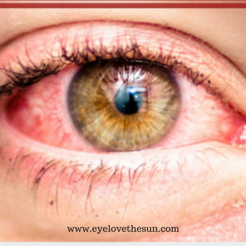 Viral Conjunctivitis