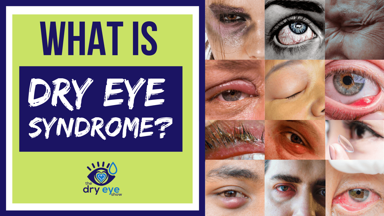 What Is Dry Eye Syndrome? Can Dry Eyes Cause Blurry Vision?